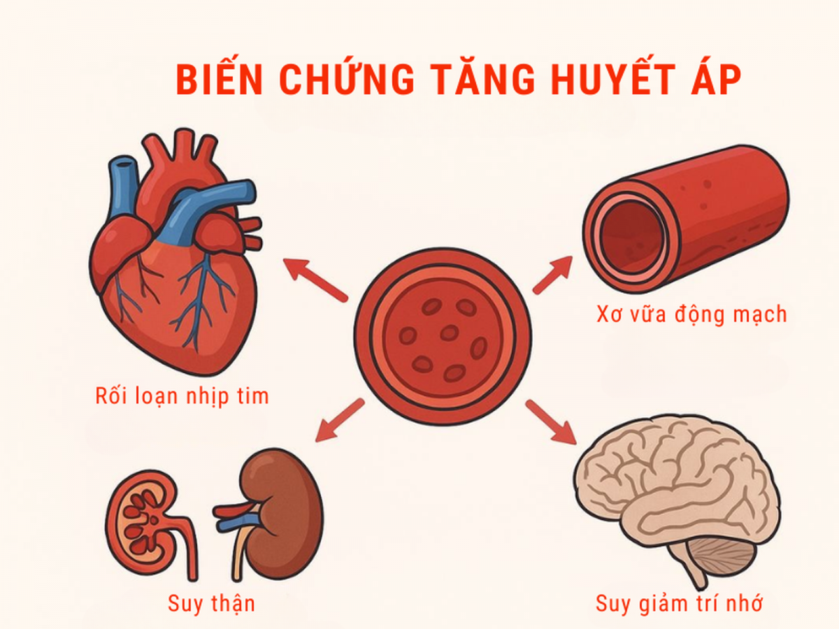 Không chỉ gây đột quỵ, huyết áp cao còn ảnh hưởng không nhỏ tới não bộ.