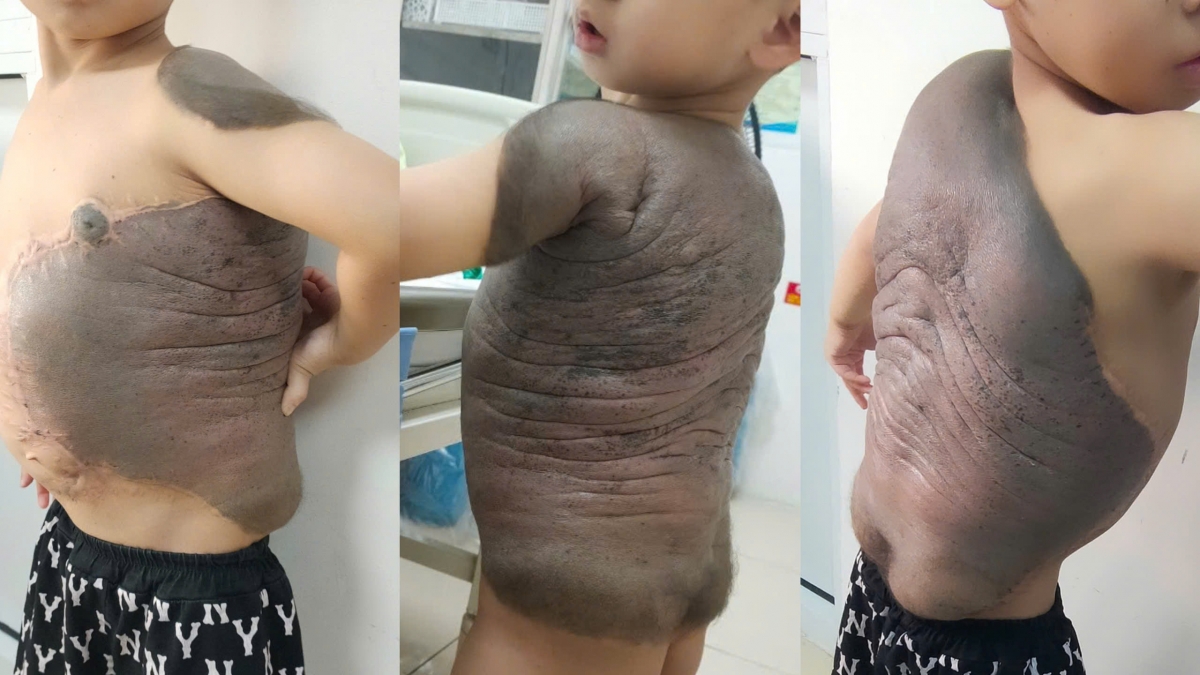 Hình ảnh bé N.V.T (7 tuổi, Hà Nội) do Bệnh viện cung cấp