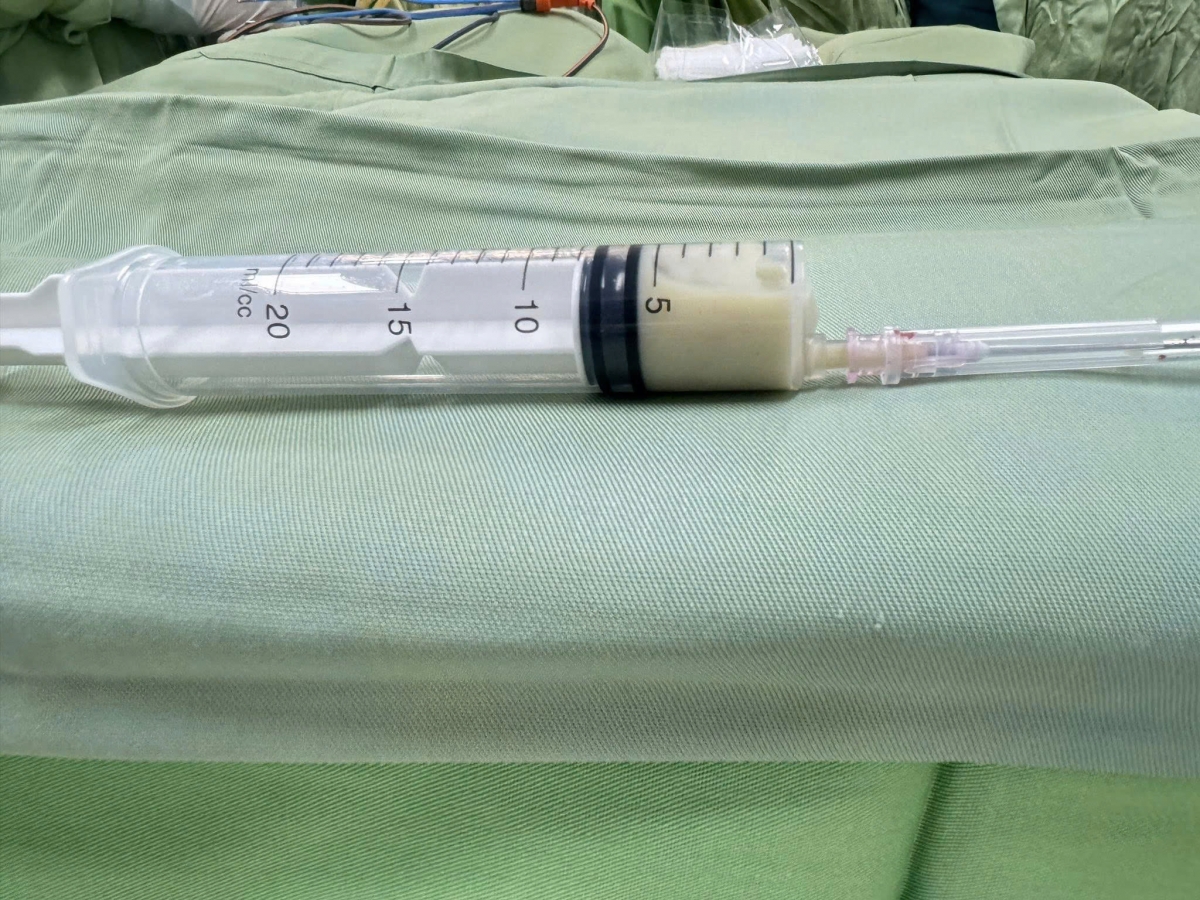 Dịch mủ tại khoang âm đạo của bệnh nhân được dẫn lưu ra ngoài Ảnh: BVCC