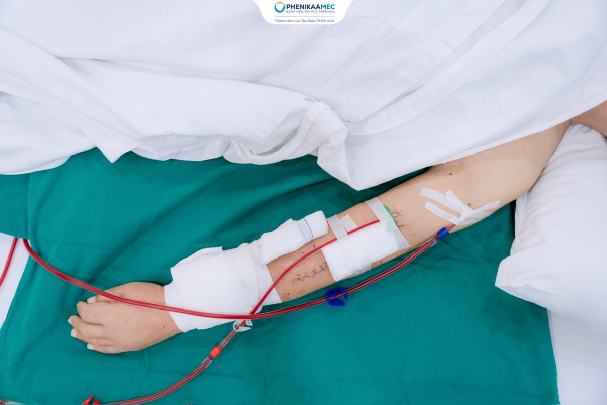 Anh B.V.C được lọc máu an toàn ngay sau can thiệp trên chính cầu nối AVF đã được bảo tồn
(Ảnh: BVCC)