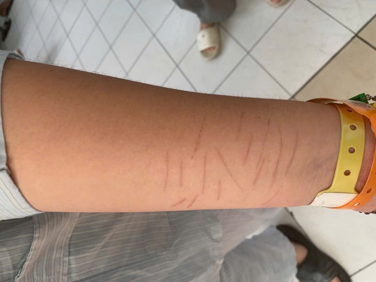 Thay vì tâm sự với gia đình, một bệnh nhân lấy dao tự rạch tay để giải tỏa áp lực trong cuộc sống
Ảnh: BVCC
