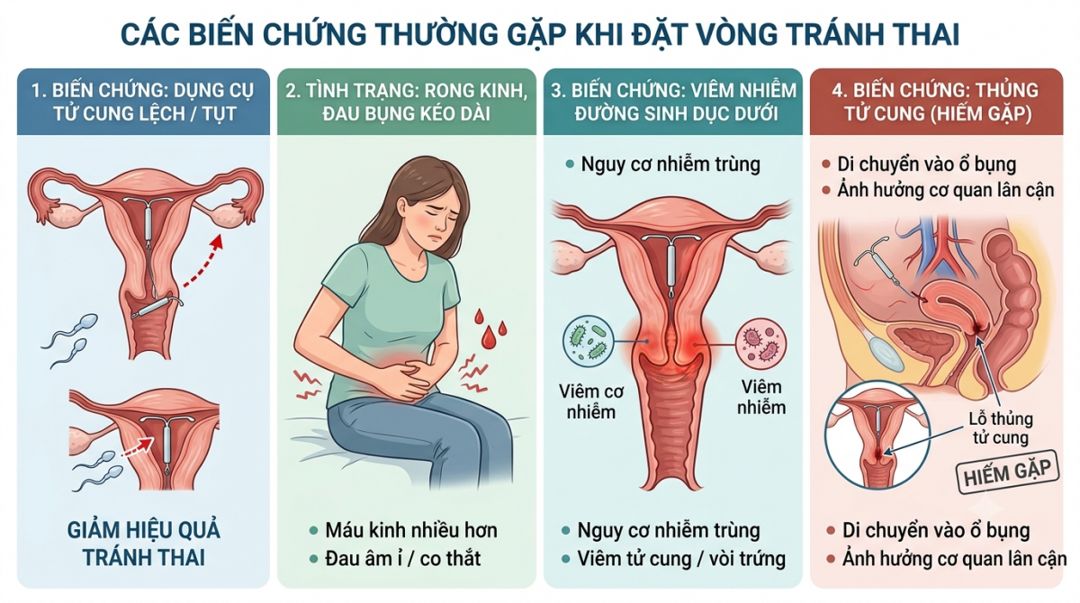 Các biến chứng có thể xảy ra khi sử dụng vòng tránh thai. Ảnh minh họa