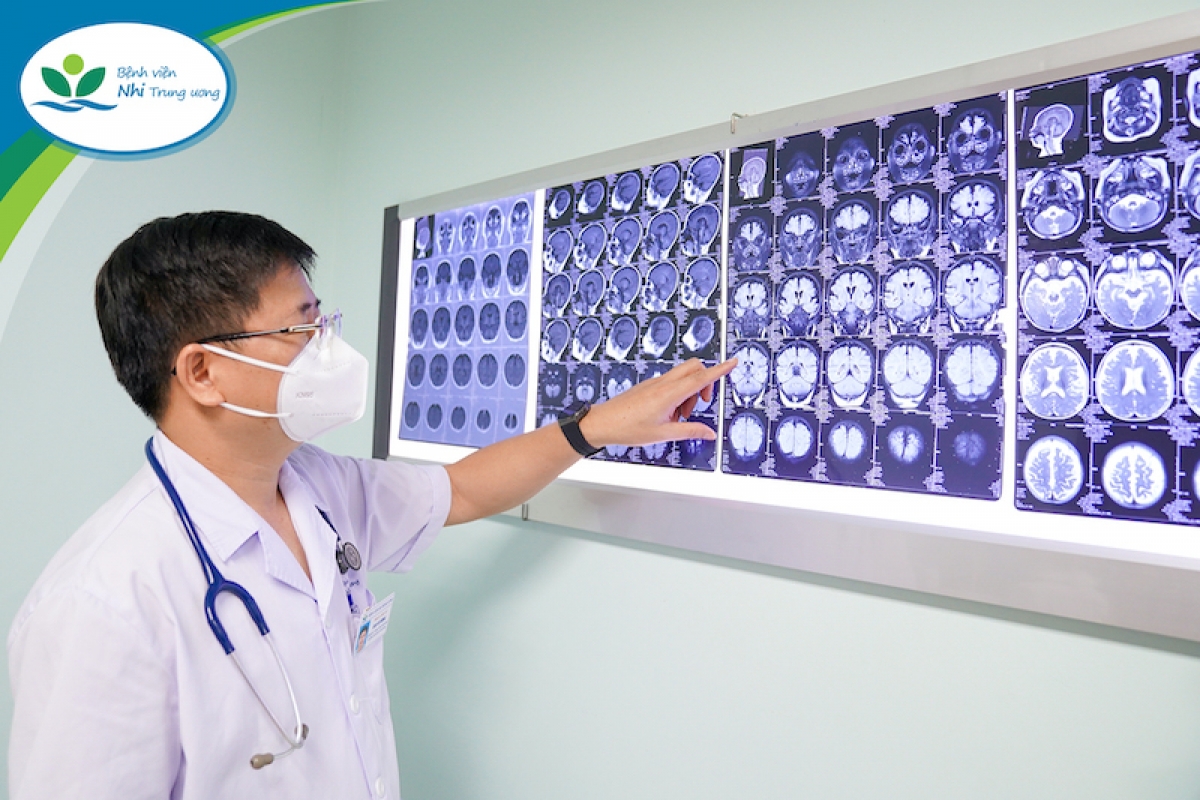 Chậm trễ trong phát hiện và điều trị khiến trẻ bị động kinh bỏ lỡ cơ hội điều trị sớm và điều trị đúng. (Ảnh: BVCC)