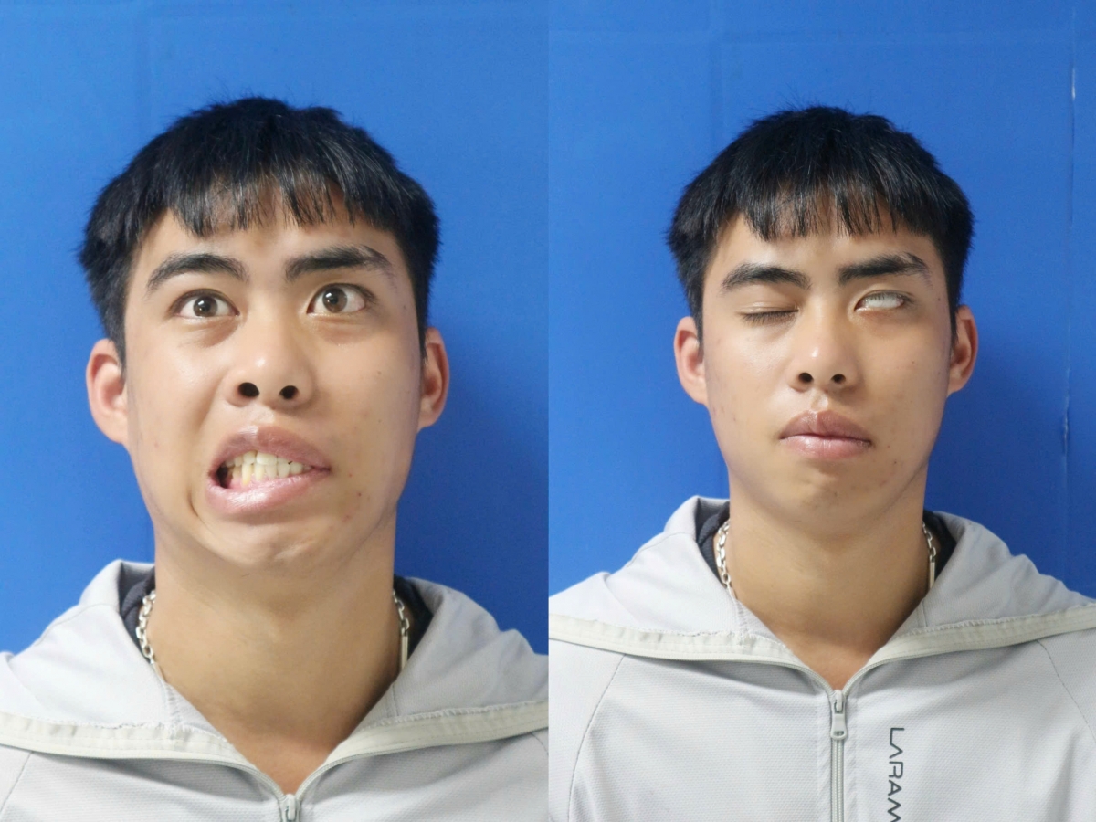 Khuôn mặt mất cân đối rõ rệt, miệng lệch sang một bên khi cười, mắt không thể nhắm kín
(Ảnh: BVCC)