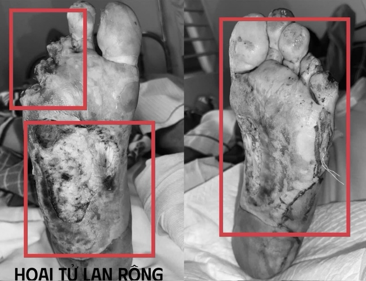 Hoại tử lan rộng ở vùng gan bàn chân sau khi ông L.V.K tự chườm nóng tại nhà (Ảnh: BVCC)